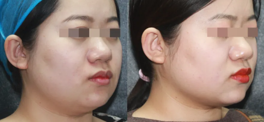 インモードVリフト症例3