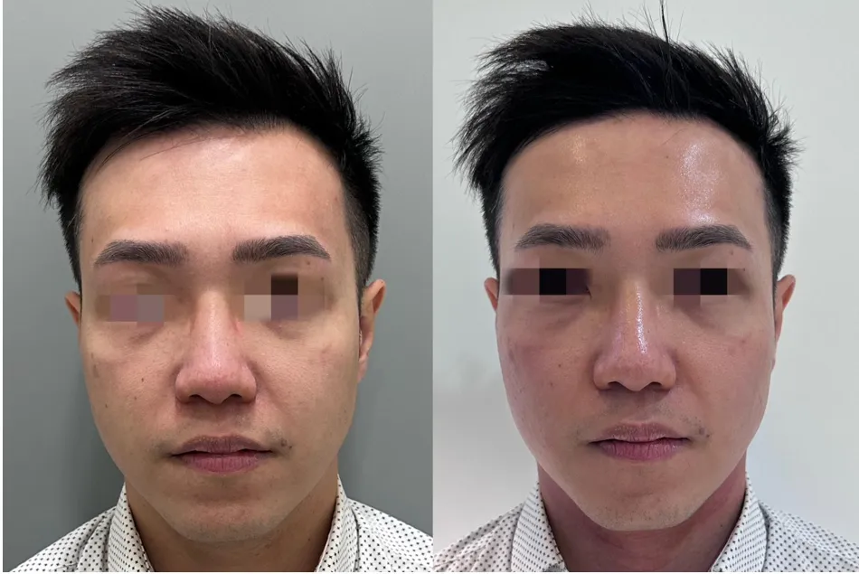 インモードVリフト症例1