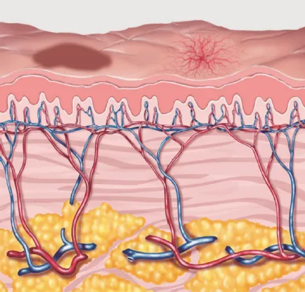 光老化により色素沈着、毛細血管拡張がある状態